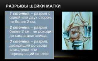 Разрыв шейки матки 2 степени при родах
