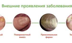 Микоз ногтей на руках что это за заболевание