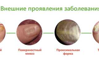 Микоз ногтей на руках что это за заболевание