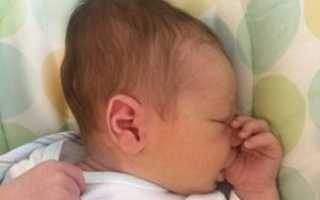 Опухоль на голове у новорожденного