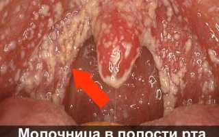 После удаления зуба молочница на десне