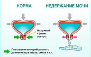 Недержание мочи при кашле во время беременности