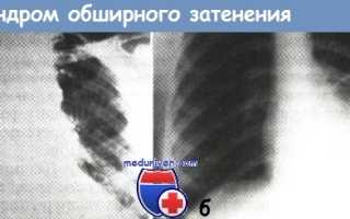 Скиалогические синдромы при туберкулезе