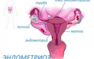 Гиперплазия эндометрия в пременопаузе форум