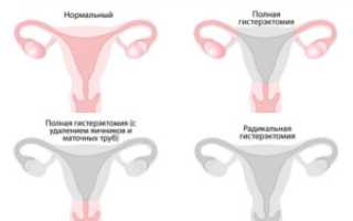 Какие последствия после удаления матки и яичников в период менопаузы