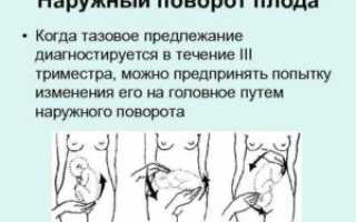 Может ли ребенок из головного предлежания перевернуться в тазовое