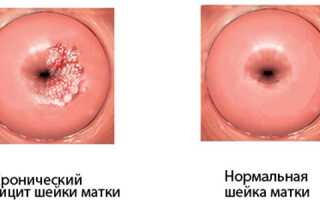 Чем лечить кандидоз в цервикальном канале