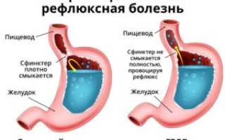 Заброс желчи в желудок при паразитах