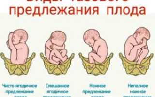 Продольное тазовое предлежание плода на 32 неделе беременности