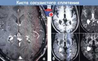 Киста сосудистого сплетения головного мозга у плода на 20 неделе